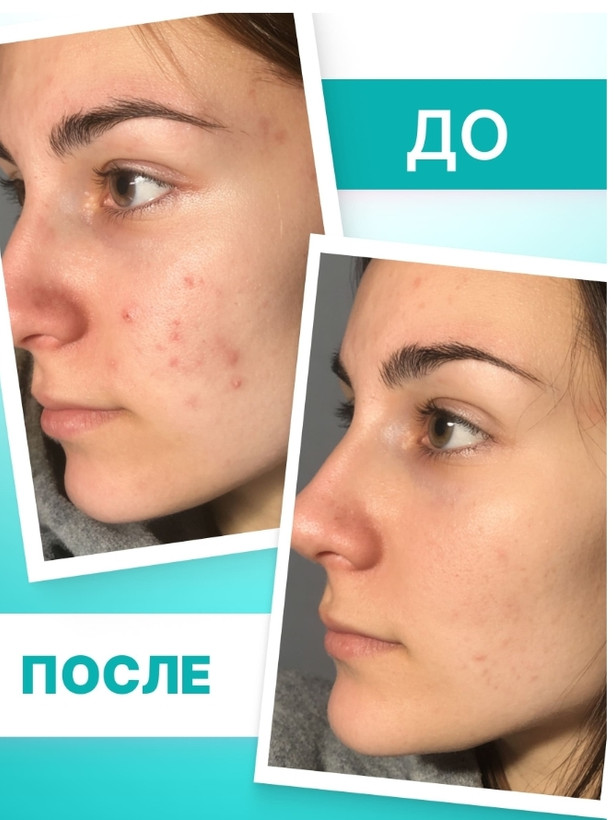 کرم TeenSkin فابرلیک Faberlic TeenSkin Spot Treatment